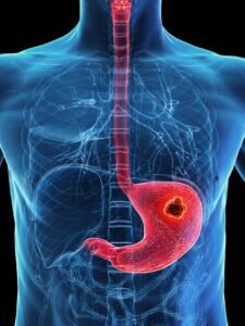 Gastric cancer tumor in the stomach