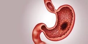 Best Gastric Cancer: Symptoms and Treatment