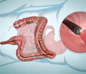 Colonoscopy: A Complete Guide to Procedure, Preparation, Benefits, and Recovery