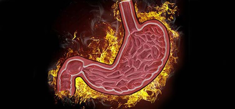 Achalasia cardia illustration showing esophagus and stomach with narrowed lower esophageal sphincter