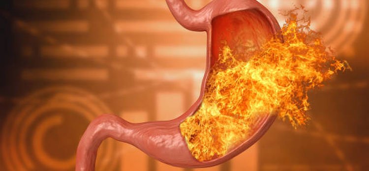 Illustration showing stomach acid causing burning sensation inside the stomach, representing acid reflux and gastritis