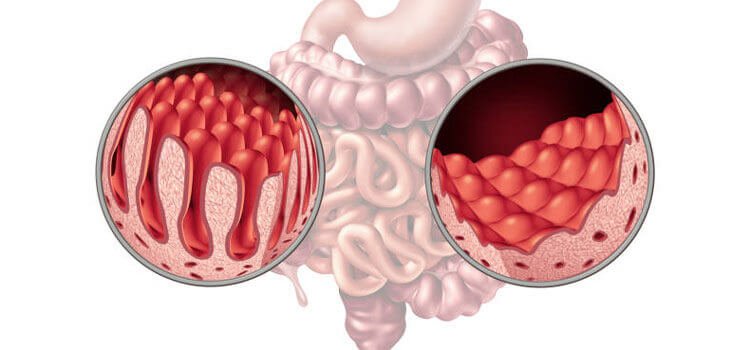 A medical illustration comparing healthy intestinal villi to damaged, flattened villi caused by celiac disease.