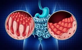 Medical illustration comparing healthy small intestine lining with finger-like villi to the flattened, blunted villi characteristic of coeliac disease.