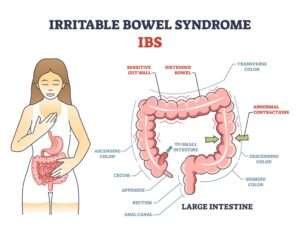 IBS Treatment in Hyderabad: Symptoms, Causes, Diet and Management